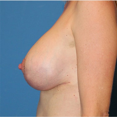 Augmentation Mastopexy And Breast Lift Side After