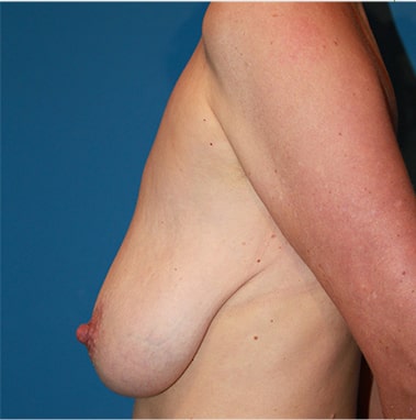 Augmentation Mastopexy And Breast Lift Side Before