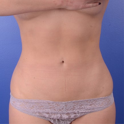 Liposuction After