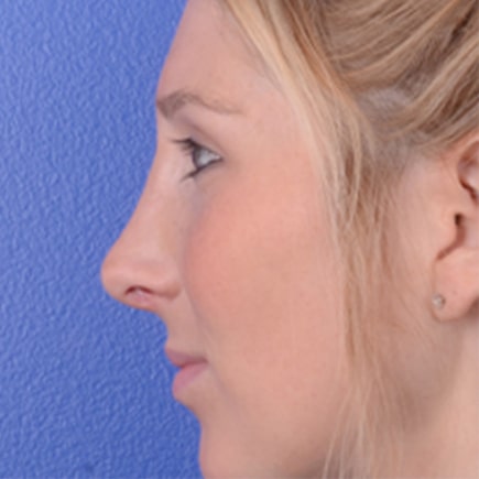 Rhinoplasty After