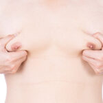 Gynecomastia vs. Chest Fat: What Every Man Should Know