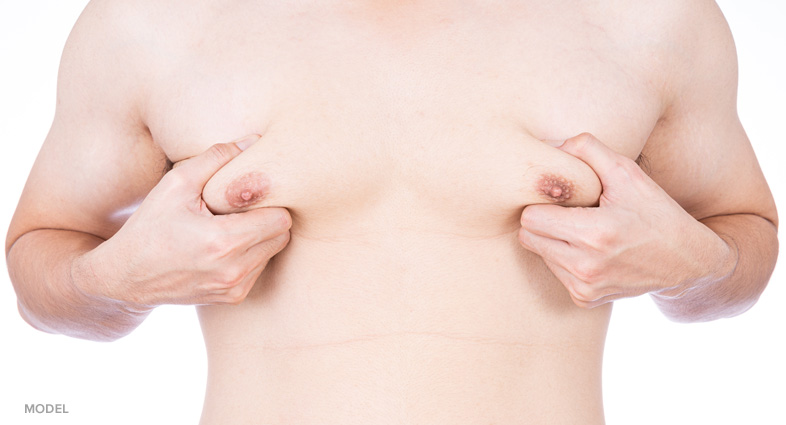 gynecomastia vs chest fat 1