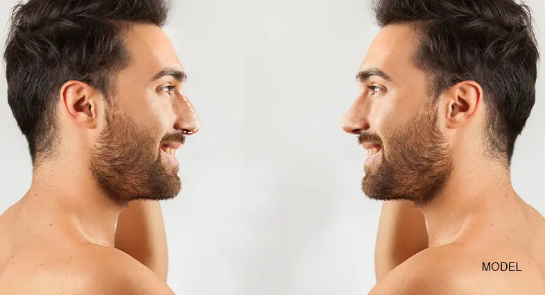 Open Vs Closed Rhinoplasty