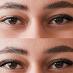 Types Of Eyelid Surgery