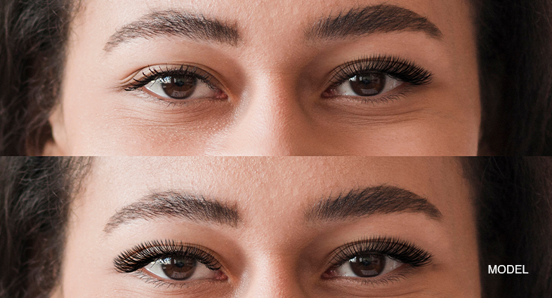 Types Of Eyelid Surgery
