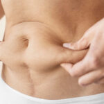 One Year After Liposuction